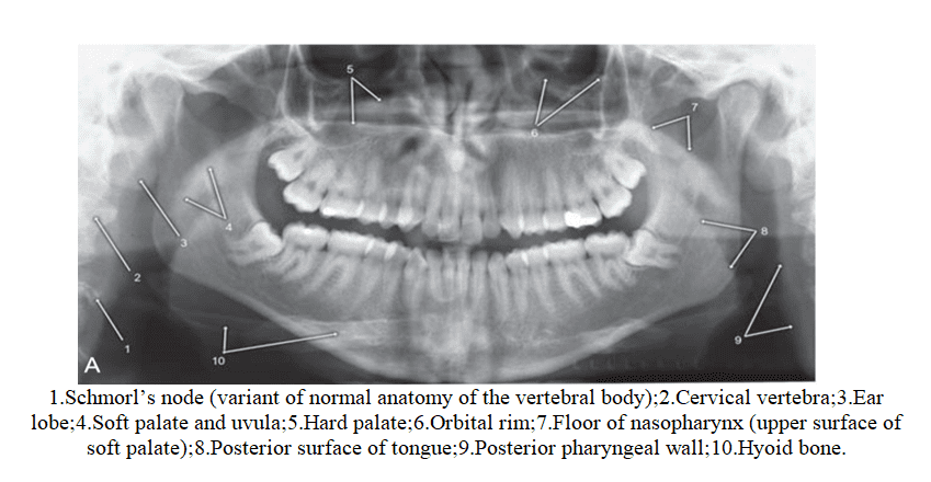 Normal Anatomic landmarks on Panoramic Radiograph - Dental Care