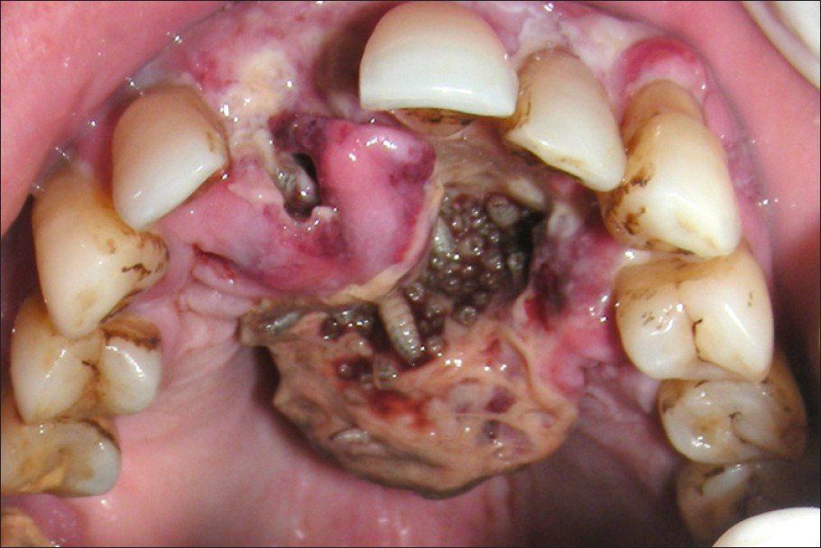 Ever wondered of having worms in your mouth????? - Dental Care