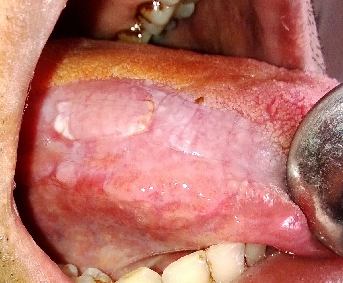 Is Oral Leukoplakia Dangerous Dental Care